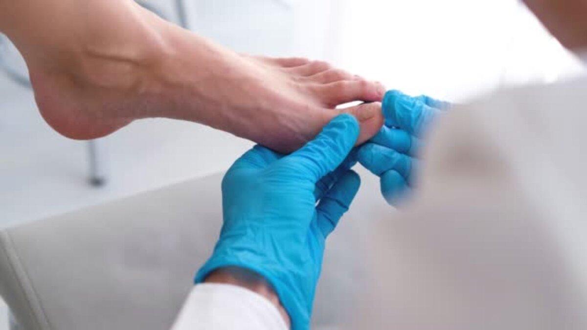 Крупный план стопы с грибком на ногтях, осмотрен врачом в перчатках. Онихолиз: отделение ногтя от ногтевого ложа. Фото автора: Irina Tiumentseva