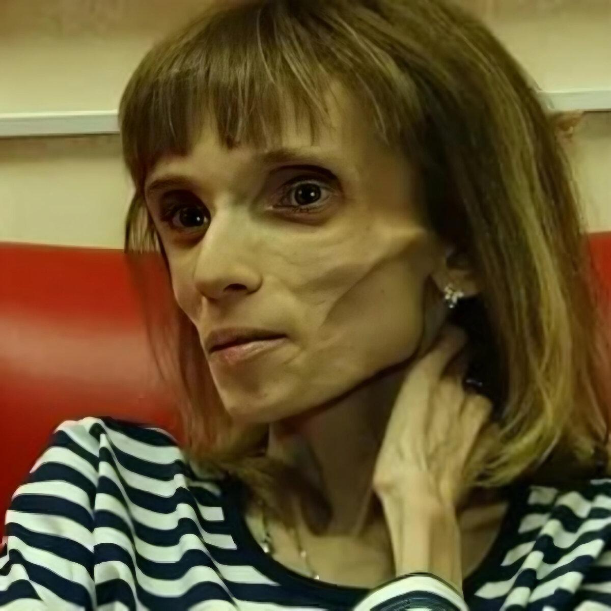 Кристина Колягина из Барнаула стала широко известна в СМИ после участия в программе "Пусть говорят". Самый низкий вес Кристины составлял всего 17 кг.-4
